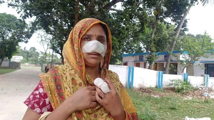 Husband chews off sleeping wife's nose, suspects her of having an affair